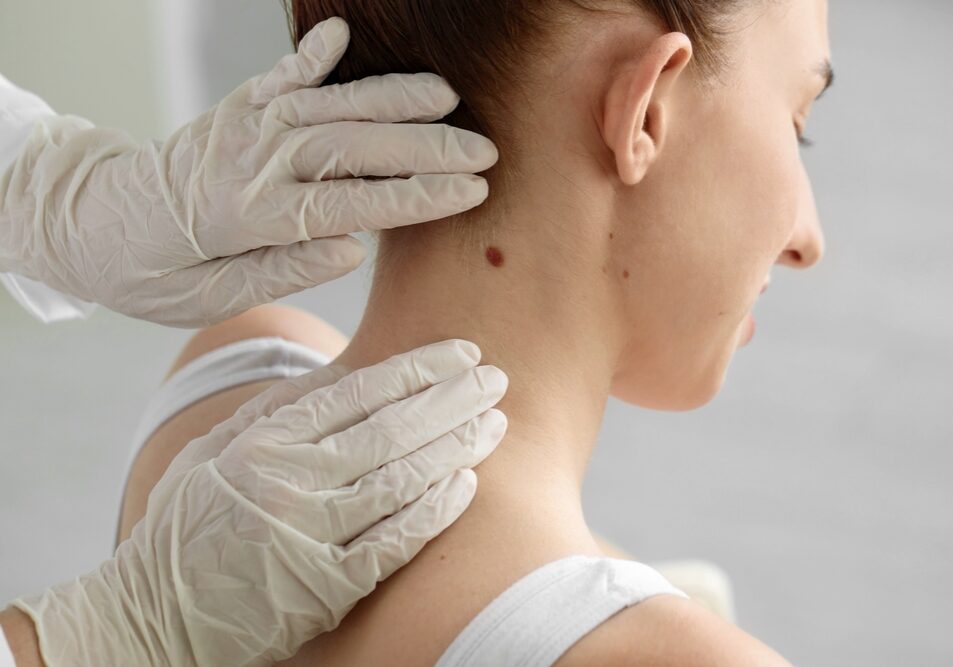 Doctor,Examining,Woman's,Mole,In,Clinic,,Closeup